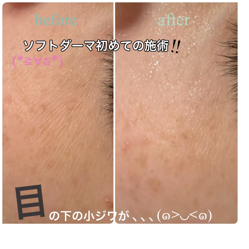 おすすめ☆ソフトダーマ☆