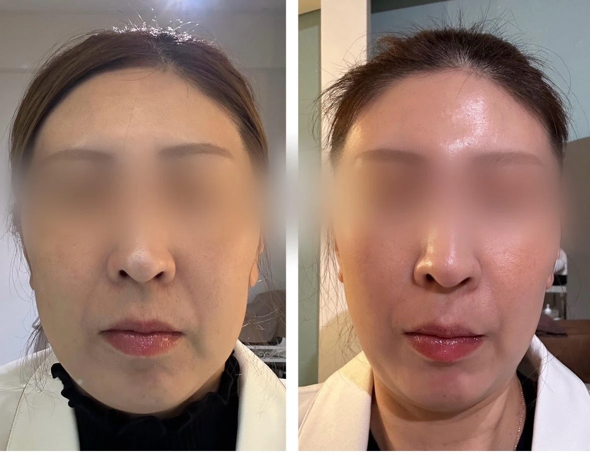 小顔になれます。