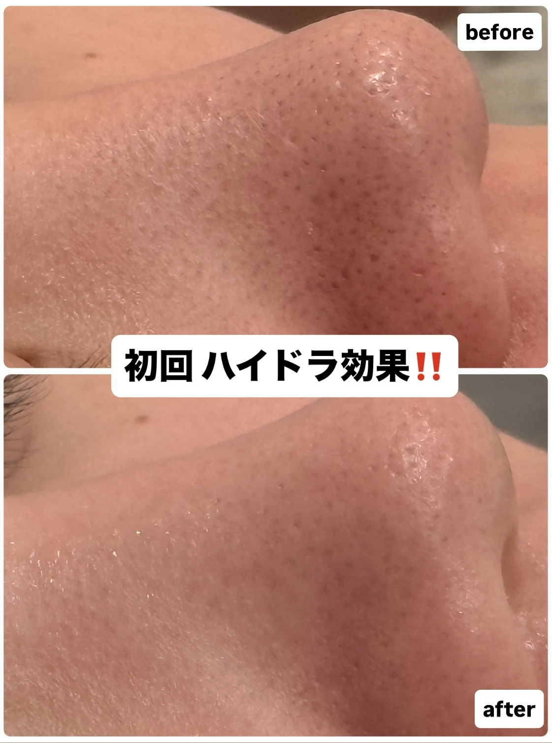毛穴の詰まり大丈夫ですか?