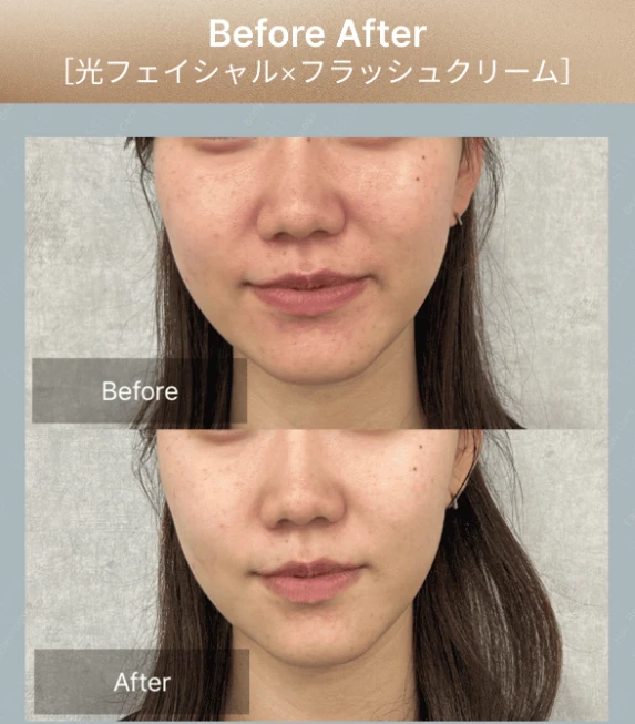 【男女OK!】プラズマ光フェイシャルで肌質改善!