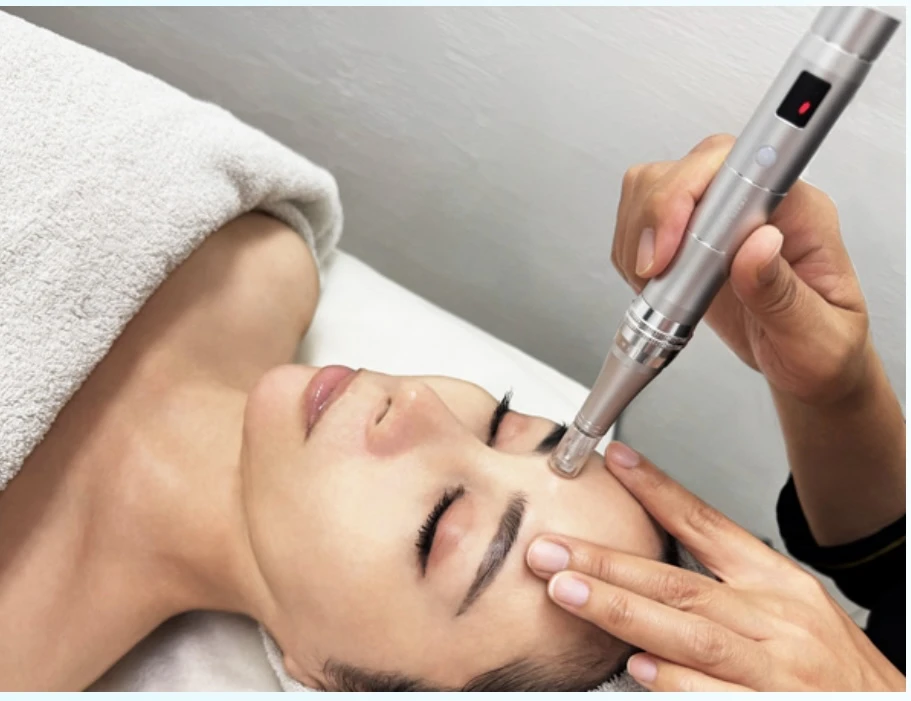 ダウンタイムなし!ソフトダーマ