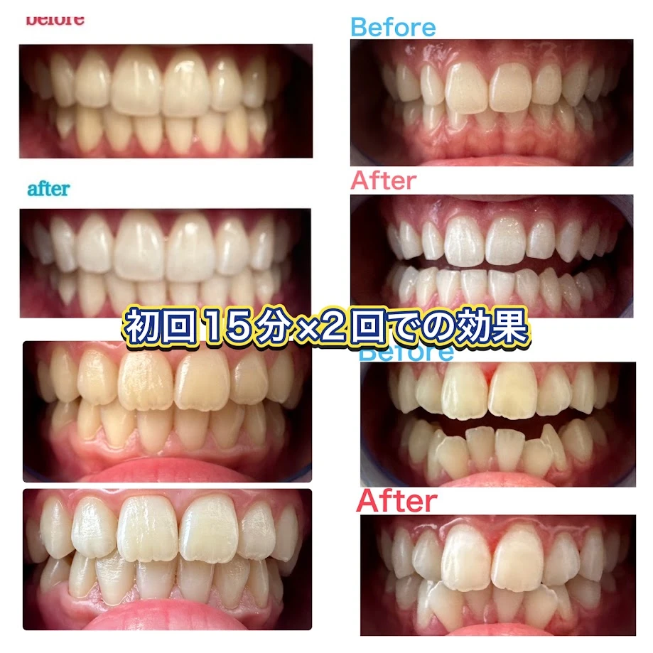 2周年キャンペーンは対象メニュー予約でホワイトニング15分×2回無料