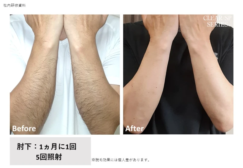 ムダ毛のチクチクなくしましょう♪